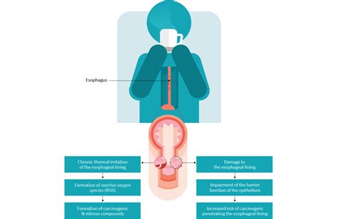 hot tea esophageal cancer diagnosis